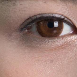 Eye Bag Removal  In Riyadh